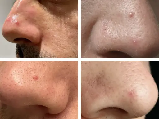 Gros plan sur le nez d'une personne, montrant des rougeurs et des petites lésions cutanées, possiblement un kyste sur le visage, nécessitant une attention médicale pour écarter tout risque de cancer.