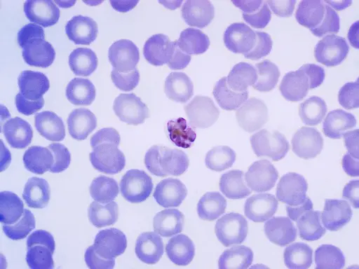 Microscopic view of red blood cells with a malaria parasite.
