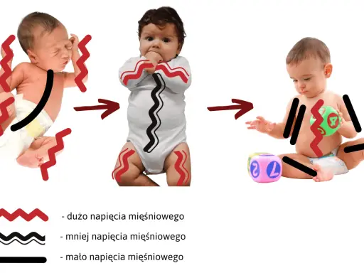 Zmiana napięcia mięśniowego u niemowląt: od wzmożonego napięcia do rozluźnienia.
