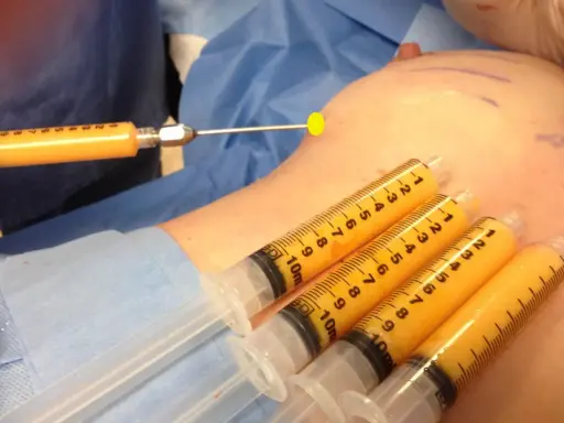 Lipofilling seno: pro e contro. Siringhe piene di grasso aspirato pronte per il rimodellamento del seno.