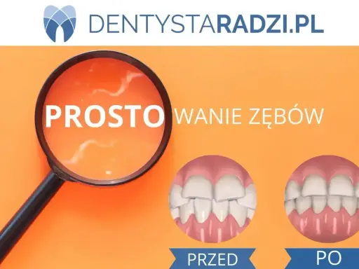 Proste licówki na krzywe zęby. Porównanie uśmiechu przed i po zabiegu.
