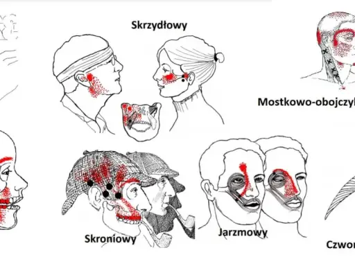 Punkty spustowe bólu w obrębie głowy i szyi, w tym mięsień skrzydłowy.