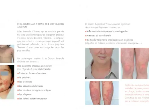 La Station thermale d'Avène traite diverses pathologies cutanées, comme l'eczéma et le psoriasis, illustrées par des photos.