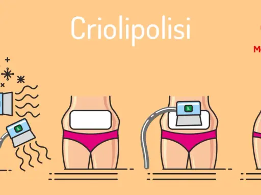 Illustrazione della criolipolisi: il processo, i benefici e i possibili criolipolisi effetti collaterali.