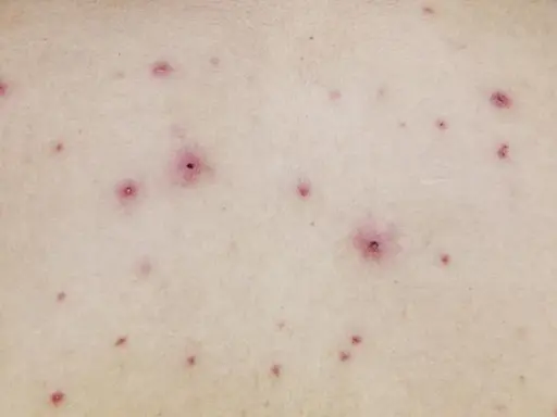 Skóra z licznymi, czerwonymi krostkami i grudkami. To mogą być ospa początki, zwiastujące chorobę.
