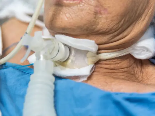 Zbliżenie na rurkę tracheostomijną u pacjenta w niebieskiej koszuli.