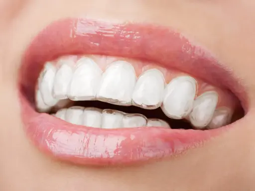 Zbliżenie na usta z widocznym aparatem Invisalign. Przezroczyste nakładki dyskretnie korygują zgryz, zapewniając piękny uśmiech.