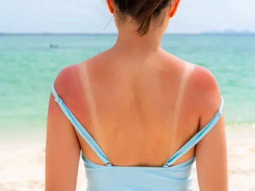 Spalle arrossate dal sole, con segni evidenti del costume. Una **pelle che non si abbronza** facilmente, ma che si scotta.