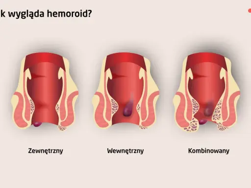 Ilustracja pokazuje trzy rodzaje hemoroidów: zewnętrzny, wewnętrzny i kombinowany. Choć hemoroidy u dzieci są rzadkie, mogą wystąpić.