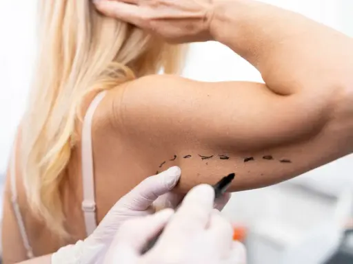 Medico disegna con pennarello su braccio, segnando una nuova tecnica per lifting braccia.