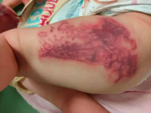 Grossa macchia violacea sulla coscia di un neonato, simile a punture di medusa (quallenstich punkte).