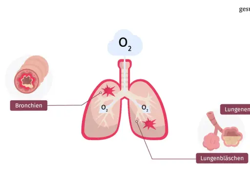 Darstellung der Lunge mit entzündeten Bronchien und zerstörten Lungenbläschen, typisch für COPD bei Rauchern.