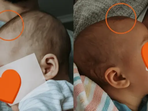 Dwa ujęcia główki niemowlaka, pokazujące jak zarasta ciemiączko. Widoczne są różnice w jego wielkości.