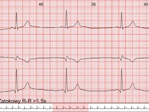 EKG z zapisem rytmu zatokowego. Widoczne są fale serca z zaznaczonymi odstępami R-R >1.5s, wskazującymi na bradykardię.