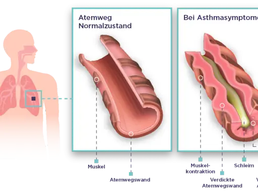 Vergleich von Atemwegen: Normalzustand vs. bei Asthmasymptomen. Bei unkontrolliertem Asthma verengen sich die Atemwege durch Muskelkontraktion und Schleimbildung.