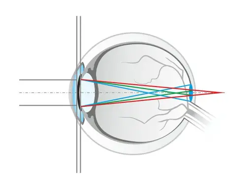 Schéma de l'œil montrant la réfraction des rayons lumineux rouge, vert et bleu. La lumière bleue est plus déviée, illustrant qu'est ce que la lumière bleue.
