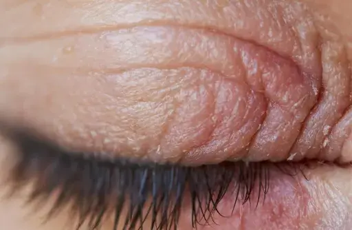 Gros plan sur un œil fermé, montrant la peau irritée et squameuse typique de l'eczéma paupière.