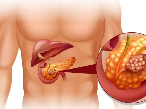 Ilustracja anatomiczna przedstawiająca trzustkę z guzem nowotworowym.