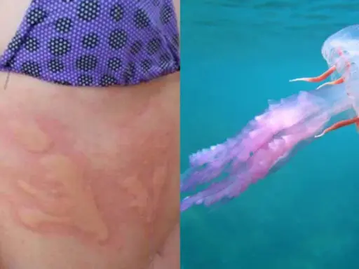 Pelle arrossata con segni di una **piqûre meduse** e una medusa rosa trasparente che nuota nell'acqua blu.