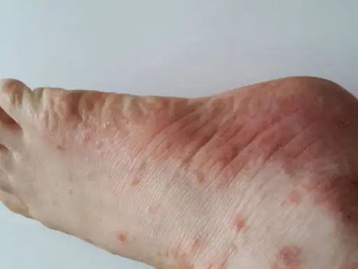 Pieds présentant des rougeurs et des petits boutons qui grattent, signe d'une irritation cutanée.