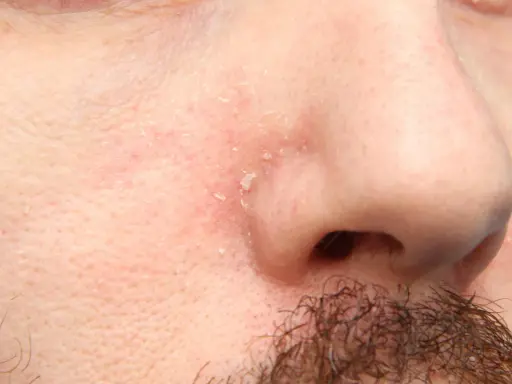 Pelle arrossata e desquamata intorno al naso, sintomo di dermatite seborroica.