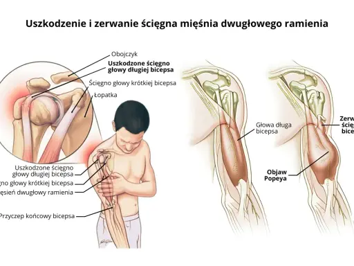 Ilustracja pokazuje uszkodzenie i zerwanie ścięgna bicepsa, powodujące ból bicepsa i objaw Popeya.