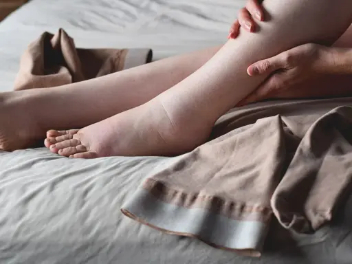 Noga z widocznym obrzękiem limfatycznym, obok leżą pończochy uciskowe.