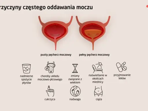 Ilustracja przedstawia przyczyny częstego oddawania moczu w dużych ilościach: nadmierne picie, choroby układu moczowo-płciowego, wiek, naświetlanie, leki, cukrzyca, nadwaga, ciąża.