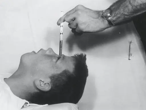 En hand för in en lobotomikniv i en patients öga. En mörk period i psykiatrins historia, även i Sverige.