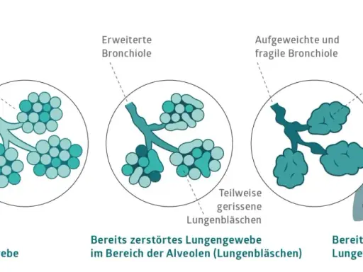 Veranschaulicht die Zerstörung von Lungenbläschen bei COPD, auch ohne Rauchen. Zeigt gesunde, erweiterte und geplatzte Lungenbläschen.