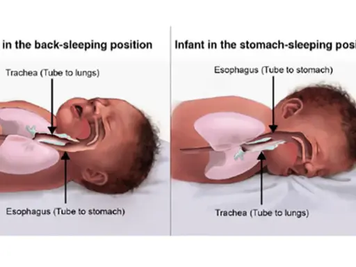 Illustrazione anatomica che mostra come far addormentare un neonato in posizione supina, con trachea e esofago liberi.