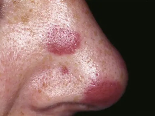 Lesioni cutanee violacee sul naso, indicative di sarcoma di Kaposi.