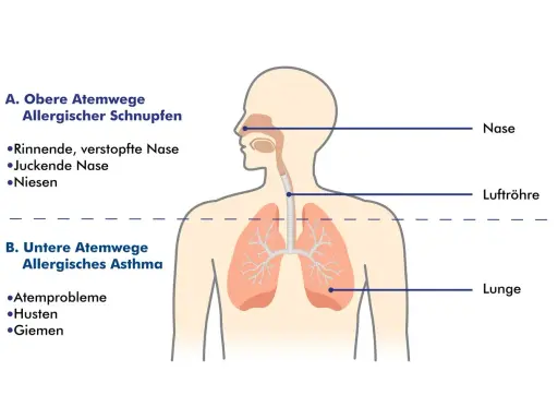 Schema zeigt obere Atemwege (allergischer Schnupfen) und untere Atemwege (allergisches Asthma). So kann man allergisches Asthma behandeln.