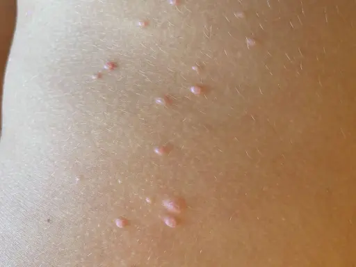 Piccolo dettaglio della pelle di un bambino con molluschi contagiosi, piccole protuberanze rosee che sembrano minuscoli molluschi.