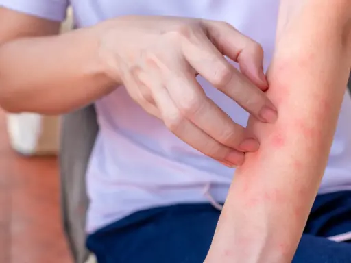 Dito, una persona si gratta il braccio, mostrando piccole macchie rosse che suggeriscono una sensazione di bruciore sulla pelle senza arrossamento visibile.