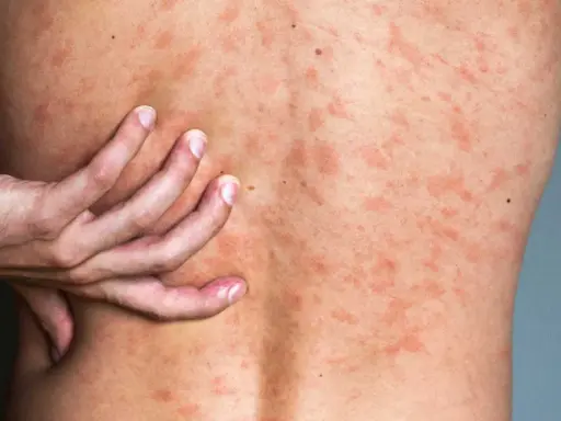 Une main gratte le dos couvert de plaques rouges, signe d'urticaire due au stress.