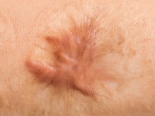 Cicatrice cheloide in rilievo sulla pelle. Esplorare i possibili rimedi per attenuarla.