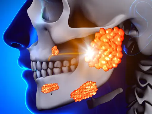 Illustrazione anatomica delle ghiandole salivari, con un focus sui possibili sintomi di un tumore ghiandole salivari: gonfiore e masse visibili.