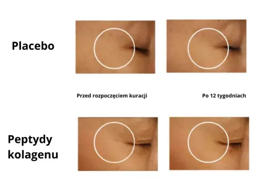 Porównanie skóry przed i po 12 tygodniach: placebo vs. peptydy kolagenu.