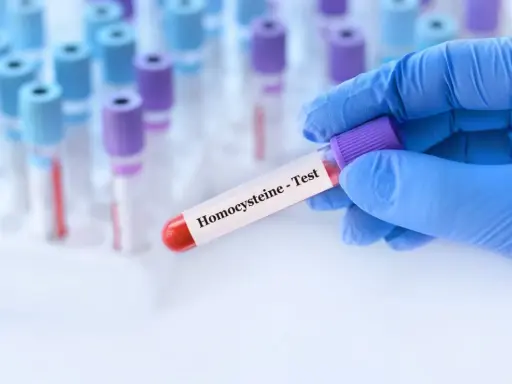 Podwyższona homocysteina: Co oznacza i jak ją skutecznie obniżyć?