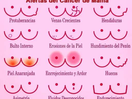 Síntomas cáncer de mama: ¿Qué señales no debes ignorar?