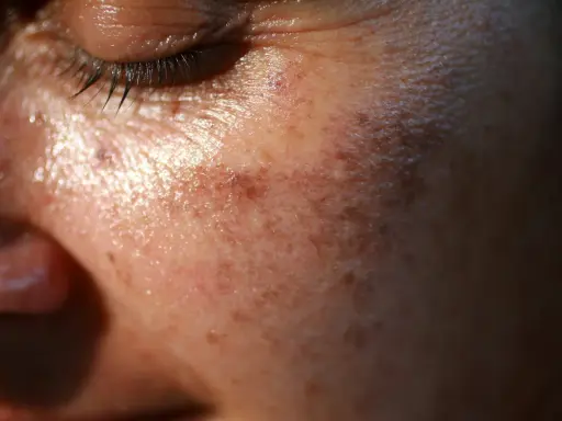 Gros plan sur la peau du visage, montrant des taches brunes. Des conseils sur comment enlever les taches brunes sur le visage pourraient être utiles.