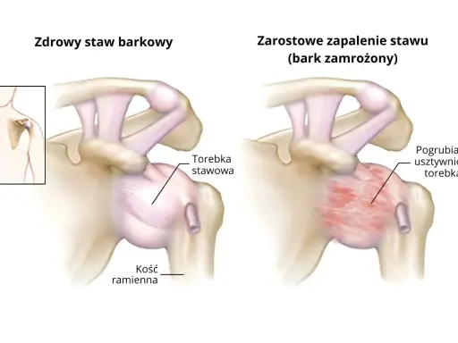 Porównanie zdrowego stawu barkowego z objawami zamrożonego barku: pogrubiała i usztywniona torebka stawowa.