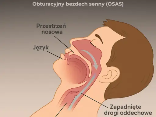 Ilustracja pokazuje przekrój głowy, wyjaśniając, **torsemed na co** wpływa obturacyjny bezdech senny (OSAS) – zapadnięte drogi oddechowe, język i przestrzeń nosową.