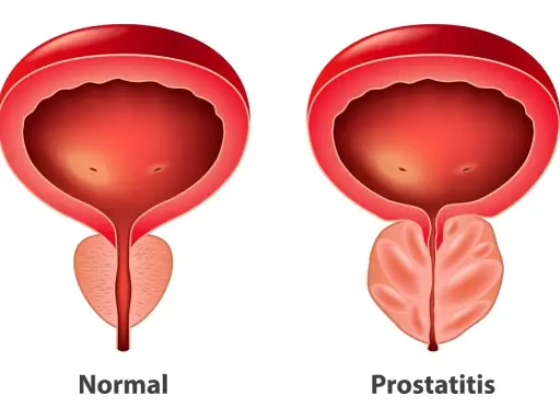 Porównanie prawidłowej i powiększonej prostaty. Zmiany w prostacie mogą objawiać się różnymi objawami.