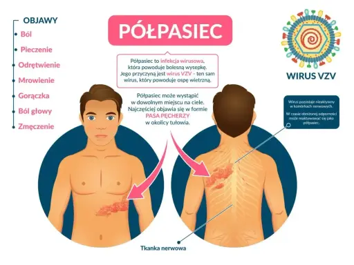 Ilustracja przedstawia objawy półpaśca, w tym ból, pieczenie i wysypkę na ciele, wskazując na nietypowe objawy półpaśca.