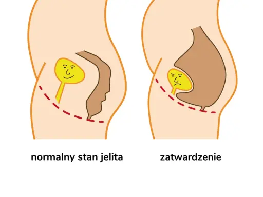 Normalne jelito z uśmiechniętą kupką vs. zatwardzenie z płaczącą kupką, co powoduje ból przy robieniu kupy.