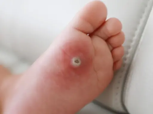 Dziecko ma kurzajkę na stopie, która jest widoczna na podeszwie.
