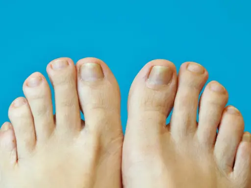 Gros plan sur des pieds montrant des ongles jaunis et épaissis, symptômes possibles de psoriasis ongle pied.