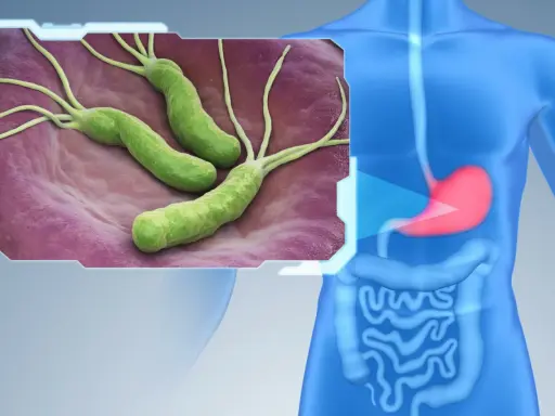 Bakterie Helicobacter pylori w żołądku. Dowiedz się, jak wyleczyć helicobacter.